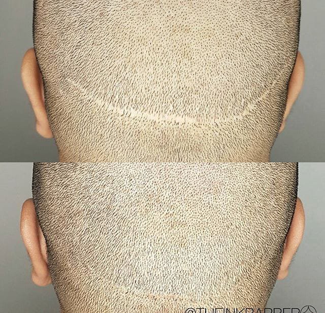 点击大图看下一张:男性头发稀疏smp头皮纹身黑色点刺技巧纹身图案