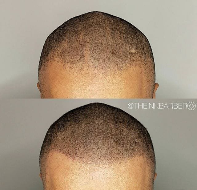 点击大图看下一张：男性头发稀疏smp头皮纹身黑色点刺技巧纹身图案