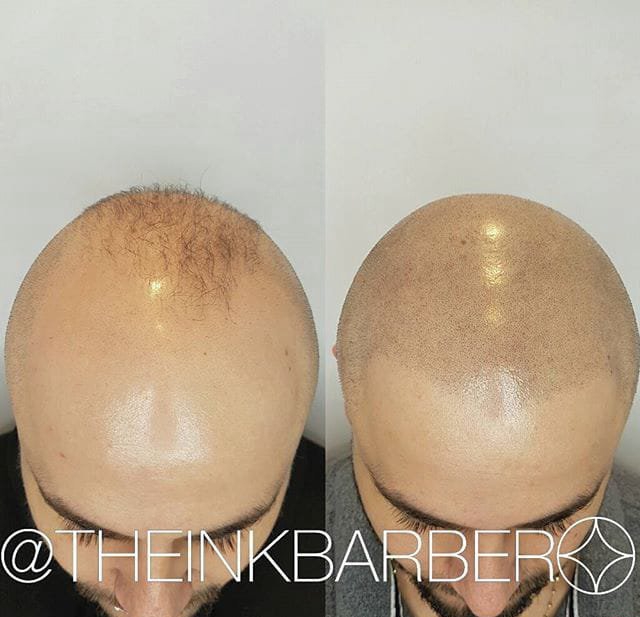 点击大图看下一张：男性头发稀疏smp头皮纹身黑色点刺技巧纹身图案