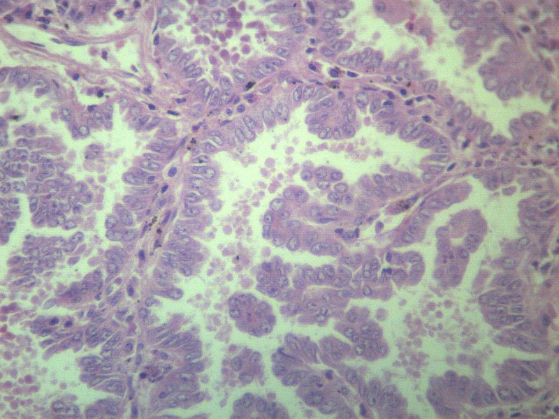 点击大图看下一张：腺癌 显微切片图片
