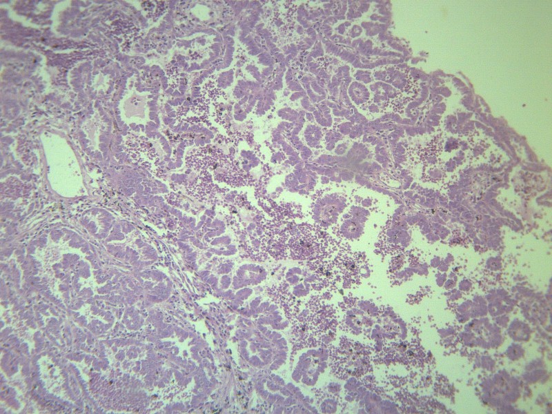 点击大图看下一张：腺癌 显微切片图片