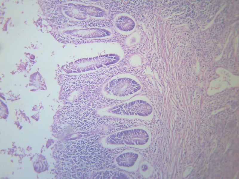 点击大图看下一张：阑尾炎 显微切片图片