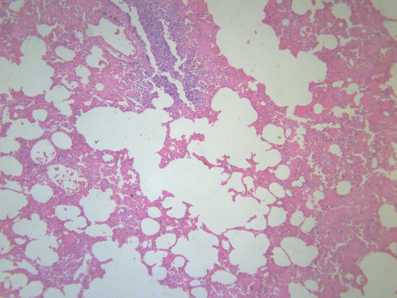 点击大图看下一张：小叶性肺炎 显微图片