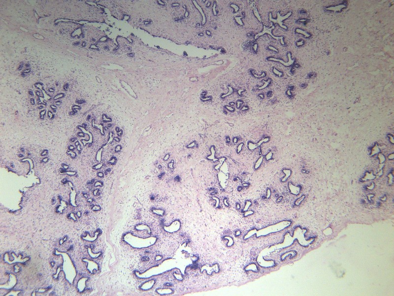 点击大图看下一张：乳腺纤维腺瘤 显微切片图片