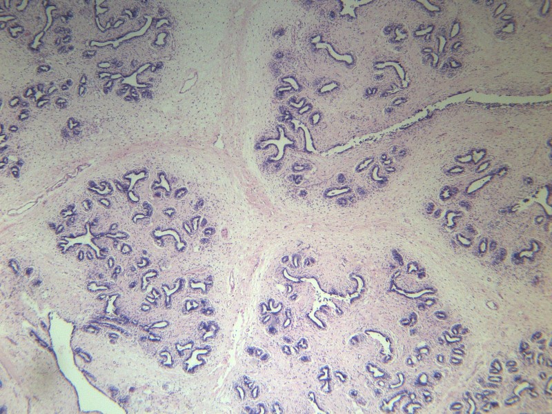 点击大图看下一张：乳腺纤维腺瘤 显微切片图片