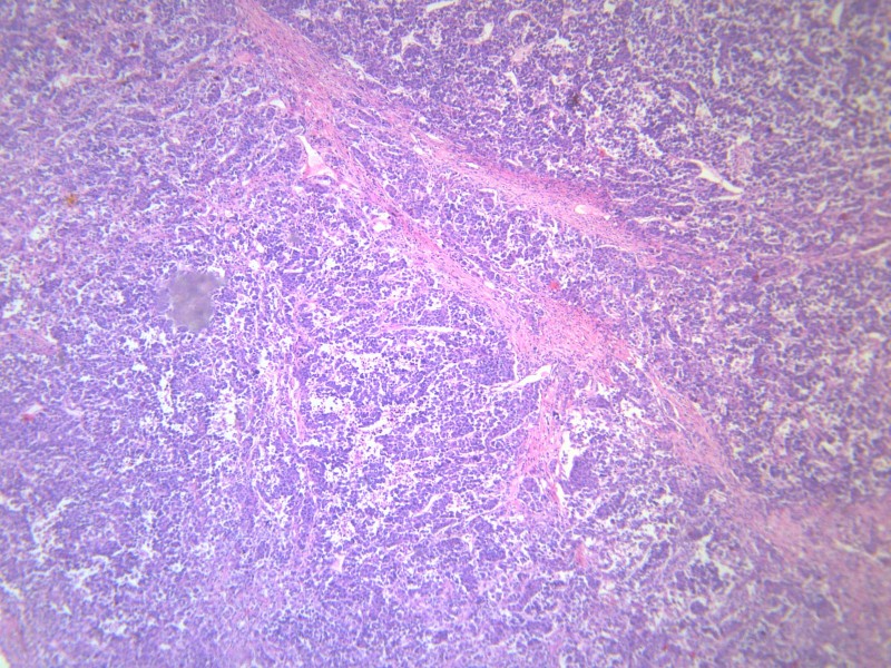 点击大图看下一张：淋巴结内转移癌 显微图片
