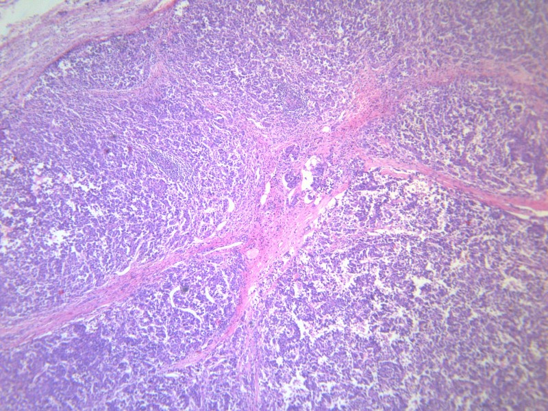 点击大图看下一张：淋巴结内转移癌 显微图片