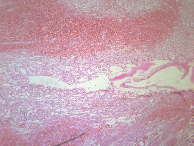 点击大图看下一张：肾小管坏死 显微切片图片