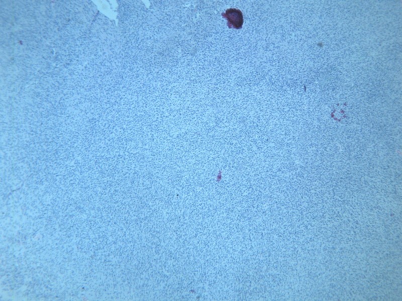 点击大图看下一张：纤维肉瘤 显微切片图片