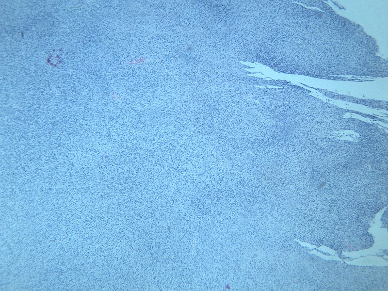 点击大图看下一张：纤维肉瘤 显微切片图片