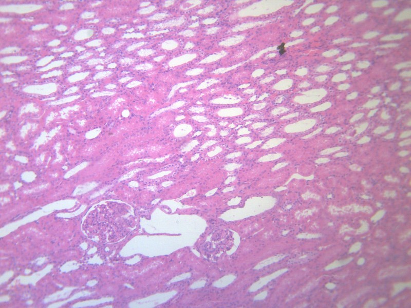 点击大图看下一张：肾小管水肿 显微切片图片