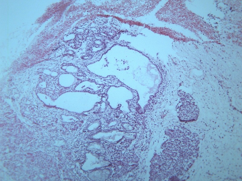 点击大图看下一张：畸胎瘤 显微切片图片