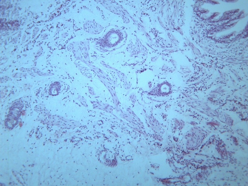 点击大图看下一张：畸胎瘤 显微切片图片