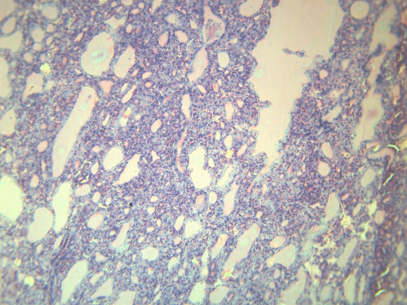 点击大图看下一张：甲状腺瘤 显微切片图片
