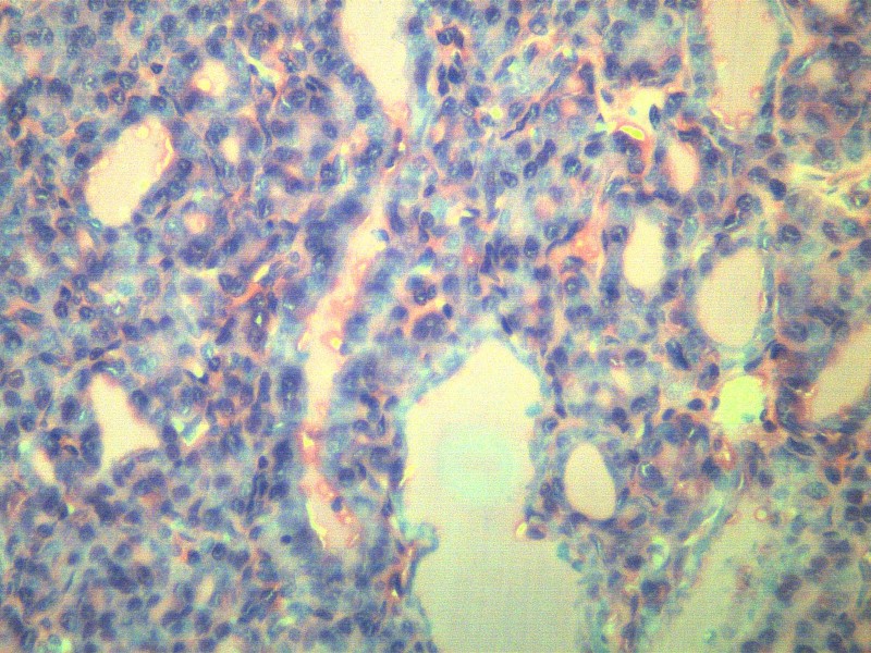 点击大图看下一张：甲状腺瘤 显微切片图片