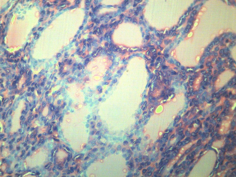点击大图看下一张：甲状腺瘤 显微切片图片