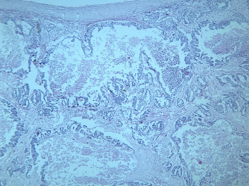点击大图看下一张：腺癌肝转移 显微图片
