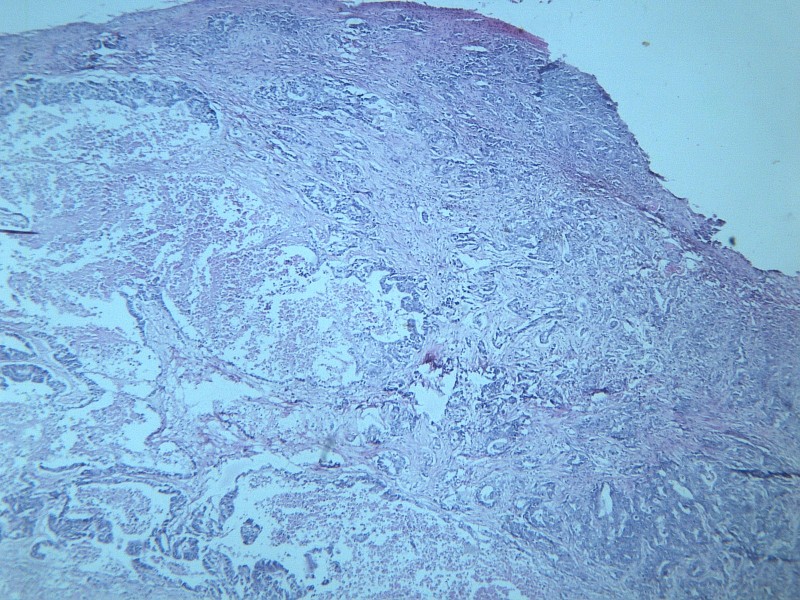 点击大图看下一张：腺癌肝转移 显微图片