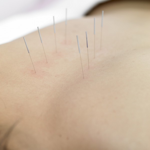 点击大图看下一张:针灸图片