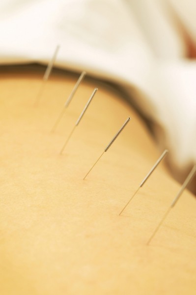 点击大图看下一张:针灸图片