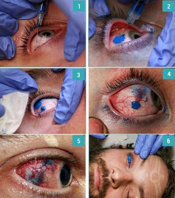 点击大图看下一张：眼球纹身过程